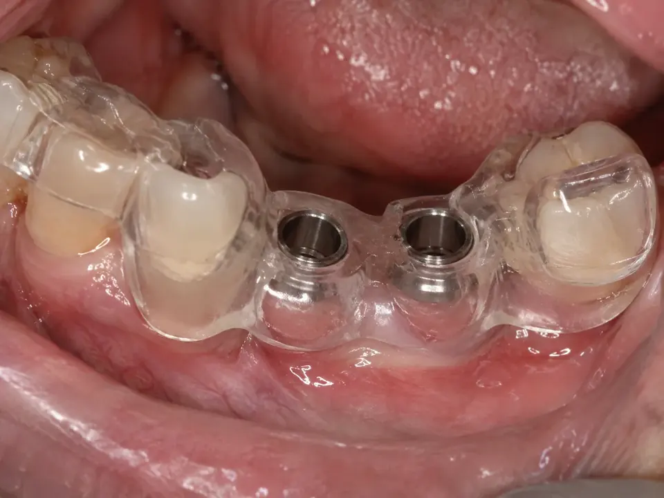 Close-up photo inside a patient's mouth. A clear surgical guide is clipped over the lower teeth, with two metal sleeves sitting over a gap where two implants will be placed.